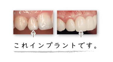 implant_ceramic