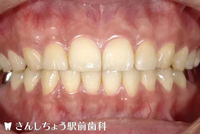 whitening-case-before